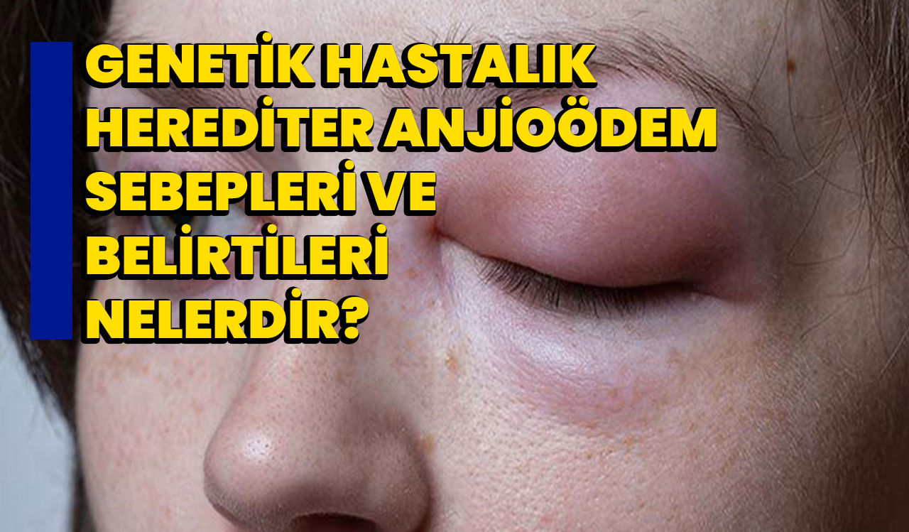 Genetik Hastalık Herediter Anjioödem Sebepleri ve Belirtileri nelerdir