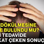 Saç dökülmesine çare bulundu mu? Yeni tedavide dikkat çeken sonuçlar