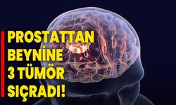 Prostattan beynine 3 Tümör Sıçradı!