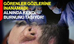 Görenler Gözlerine İnanamadı: Alnında Kendi Burnunu Taşıyor!