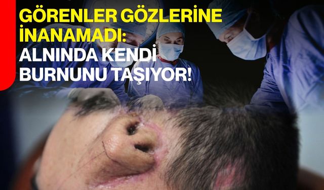 Görenler Gözlerine İnanamadı: Alnında Kendi Burnunu Taşıyor!
