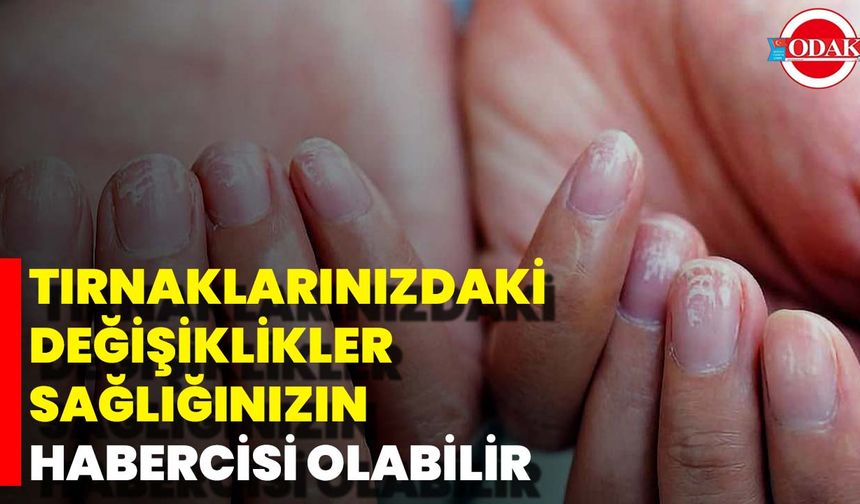 Tırnaklarınızdaki Değişiklikler Sağlığınızın Habercisi Olabilir